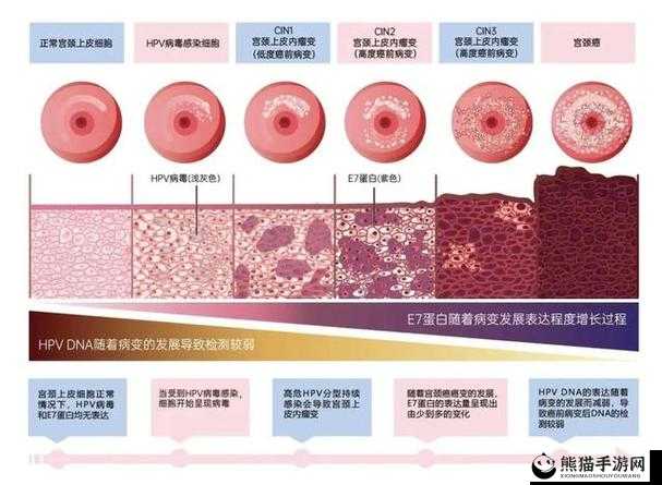 cin3 是什么意思：关于宫颈上皮内瘤变三级的详细解读